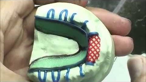 Surveying and Waxing a Removable Partial Denture