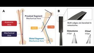 Centre of Rotation Angulation CORA ; fundamental concept in orthopedic deformity correction