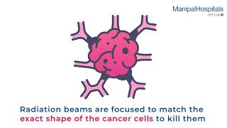 Radiotherapy Treatment Planning Process | Radiation Therapy | Manipal Hospitals India