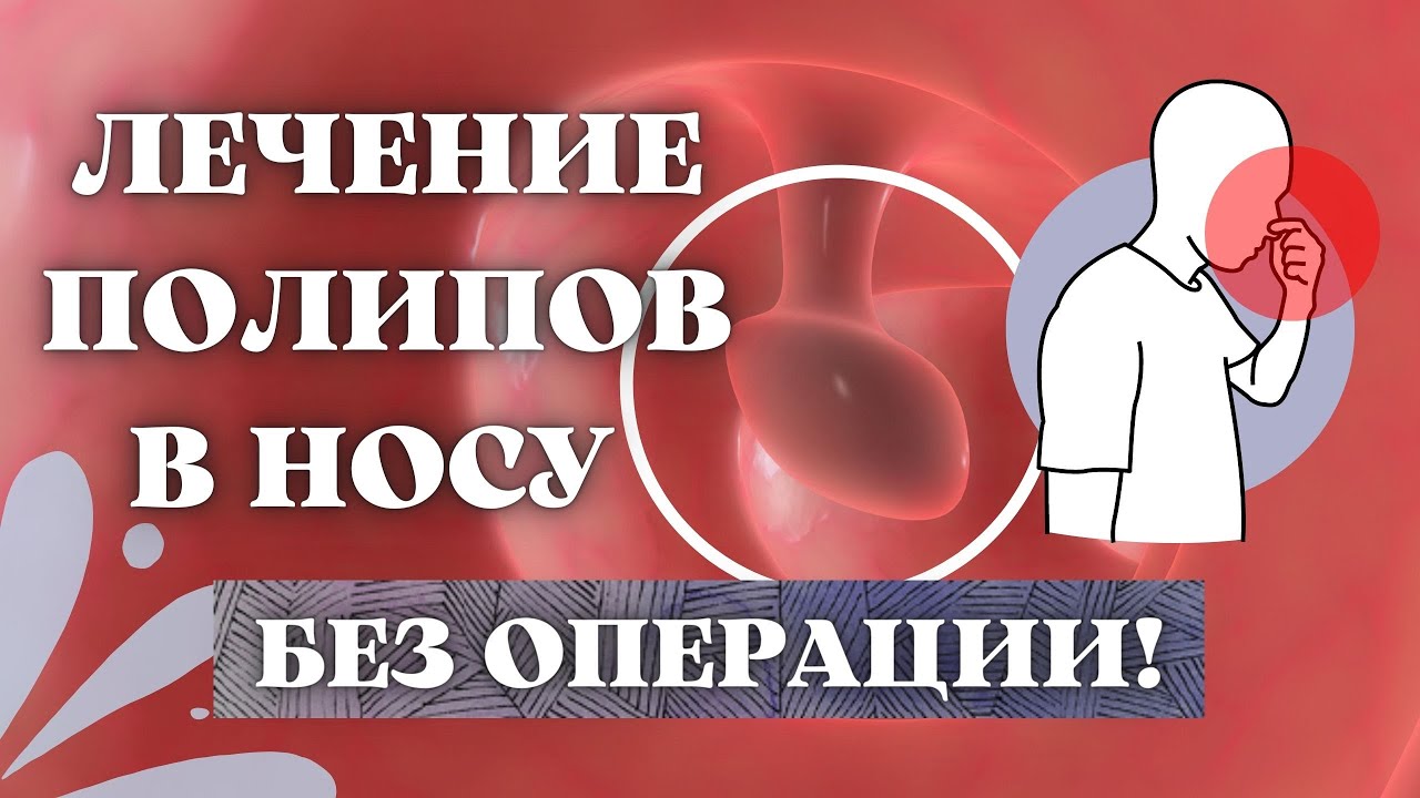 ЛЕЧЕНИЕ ПОЛИПОВ В НОСУ БЕЗ ОПЕРАЦИИ. - YouTube
