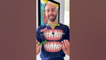 Closing a BIG Gap with Invisalign for an Adult Patient