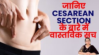 Real facts about cesarean section -Dr Asha Gavade