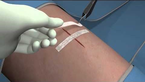 3M Steri-Strips™ Skin Closure Application | 3M Critical & Chronic Care Solutions