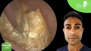 1,278 - x3 Ear Wax Removal Videos