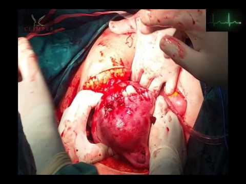 Video: De 3 Fasen Van De Partus: Dilatatie, Uitzetting En Placenta