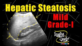 Mild Hepatic Steatosis || Mild Fatty Infiltration || Ultrasound || Case 170