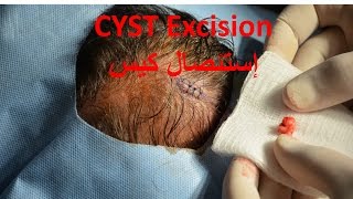 Excision of a Cyst over Scalp إستئصال كيس من فروة الرأس