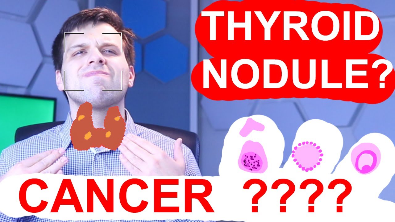 Thyroid Nodules - Are They A Cancer?