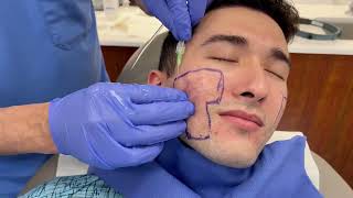 Ellacor for Acne Scars | Treating Deep Acne Scarring with Dr. Jochen | Contour Dermatology