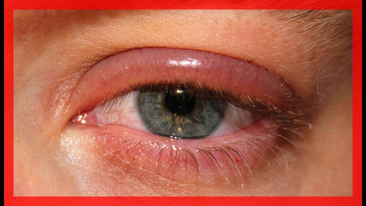 Remedios caseros para la blefaritis o inflamación de los parpados YouTube Remedios caseros para la blefaritis o inflamación de los parpados YouTube
