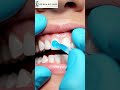 Gap Between Teeth Fixed Instantly #beforeafter #dentist #dentalartistry #cavity #teethdecay #repair