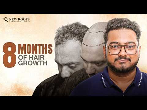 Natural-Looking Hair After Hair Transplant! 😍 | 8 Months Results | Hair Transplant Cost in Kolkata