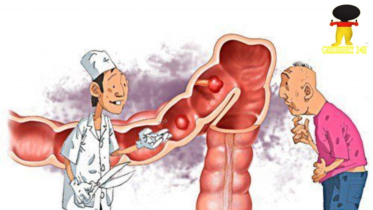 Diät zur Heilung von Colitis ulcerosa Diät zur Heilung von Colitis ulcerosa