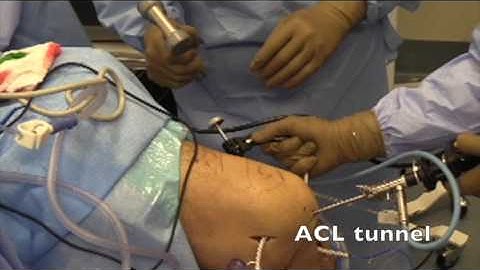 ACL/MCL/PCL Reconstruction