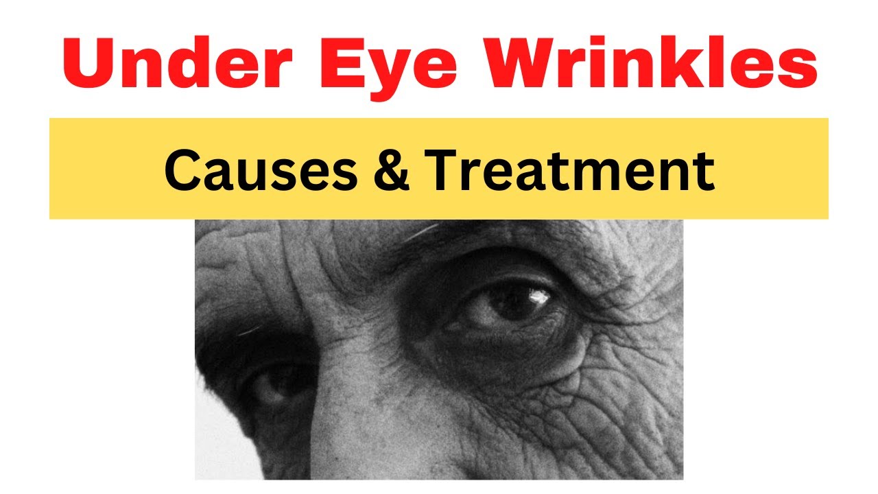 Under Eye Wrinkles | Treatment & Causes - YouTube