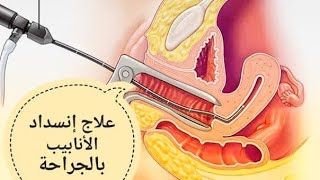 فتح الأنابيب بالجراحة