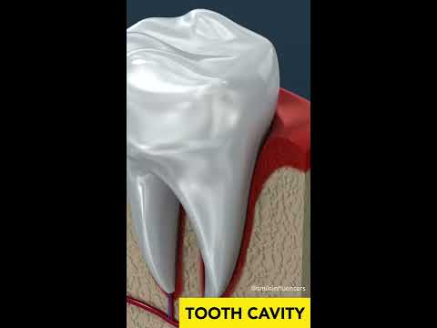 Tooth Cavity Root Canal
