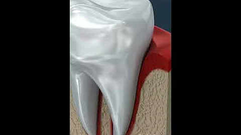 Tooth Cavity & Root Canal - DayDayNews