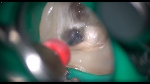 90-degree preparation for visible broken file removal, followed by BF removal with an XPS