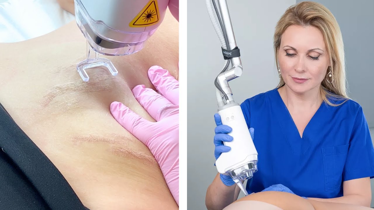 Laser για Ραγάδες 