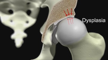 Acetabular Dysplasia