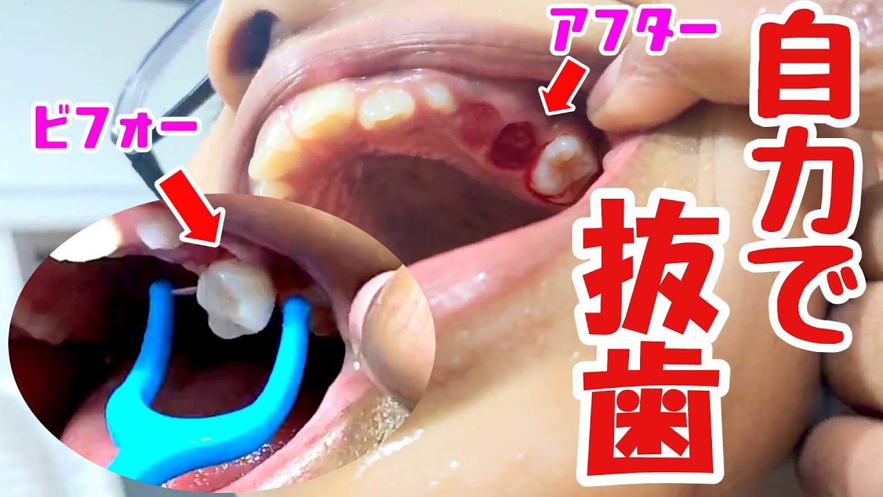 ぐらぐら の 歯 を 抜く 方法