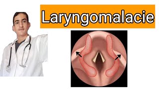 la laryngomalacie