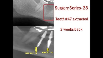 2nd mandibular molar extraction & immediate cortical dental implants