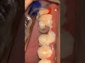 Dental Health - Personal Teeth Care
