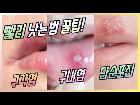 (ENG SUB) Three diseases of the lip. Ways to cure them in one-two days! | Dr. Dinho