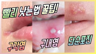 (자막) 입술질환 3가지(구내염/구각염/단순포진) 1~2일 만에 낫는 법! 꿀팁! l 닥터딩요