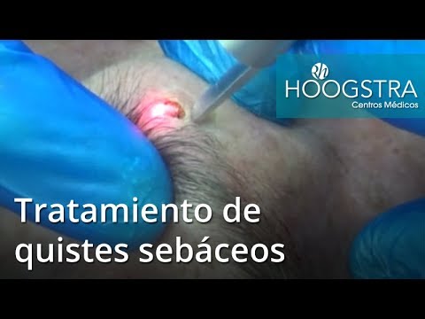 tumor benigno em ingles Tratamiento de quistes sebáceos (19013)
