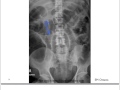 Small bowel obstruction