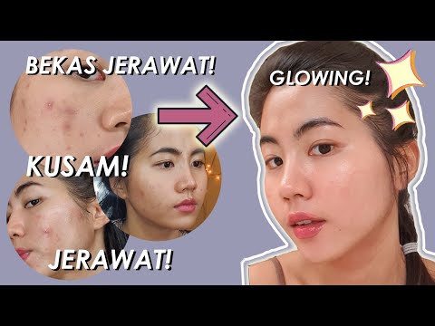 REVIEW GARNIER MEN ACNE GEL | Cara menghilangkan jerawat cepat dalam 2 Jam Hii Guys ~ Kembali ke You. 