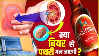 क्या बियर पीने से पथरी जल्दी निकल जाती है | Beer for Kidney Stones benefits