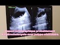 Aspect échographique probablement d'hydrocholecyste avec polype vésiculaire.