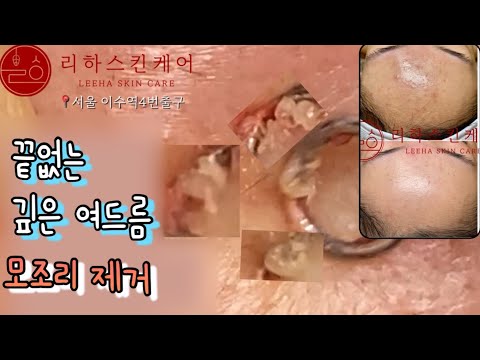 이마 여드름 때문에 결국 여기까지 왔어요.속에서 이런게 나와요?