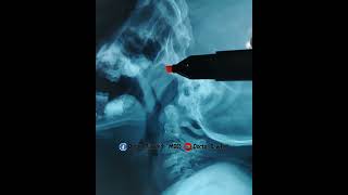adenoid hyperplasia #surgery #ent #adenoid