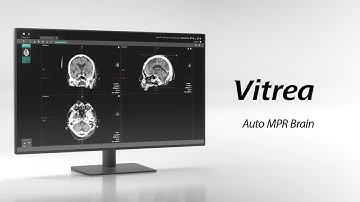 Vitrea Automated Workflow – Auto MPR Brain | JIT MPR Reformatting