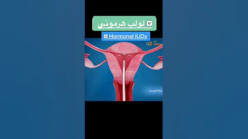 طريقه تركيب لولب هرموني Shorts 