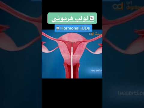 طريقه تركيب لولب هرموني 
