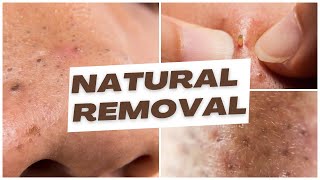 Discover the Truth About Natural Blackhead Removal