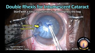 CataractCoach™1755: double rhexis for intumescent white cataract