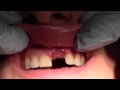 Bone Grafting #9 Site, Mineross &amp; Memlok, 1 week post-op