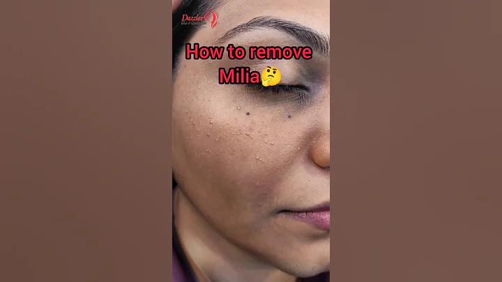 How to remove milia?🤔#skincare #skin #clearskin #white pimple on face #shortvideo #shorts