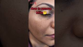How To Remove Miliaskincare skin clearskin white Pimple On Face short shorts