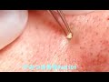 【acne pimple】やみつき角栓Part102