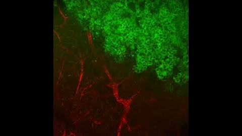 Tumor Cells in Motion