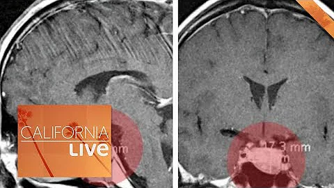 The Supplement That Helped a Doctor With His Brain Tumor  | California Live | NBCLA - DayDayNews
