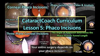 CataractCoach 1581: curriculum lesson 5: phaco incisions